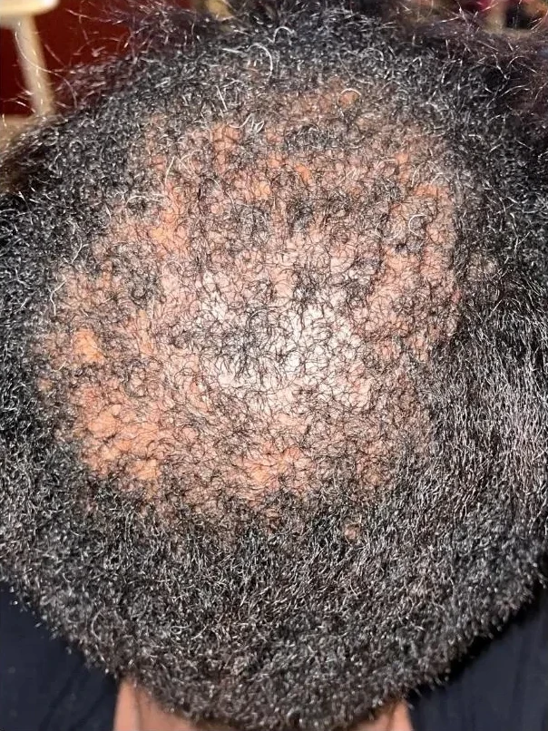 CCCA scalp at intake, week zero