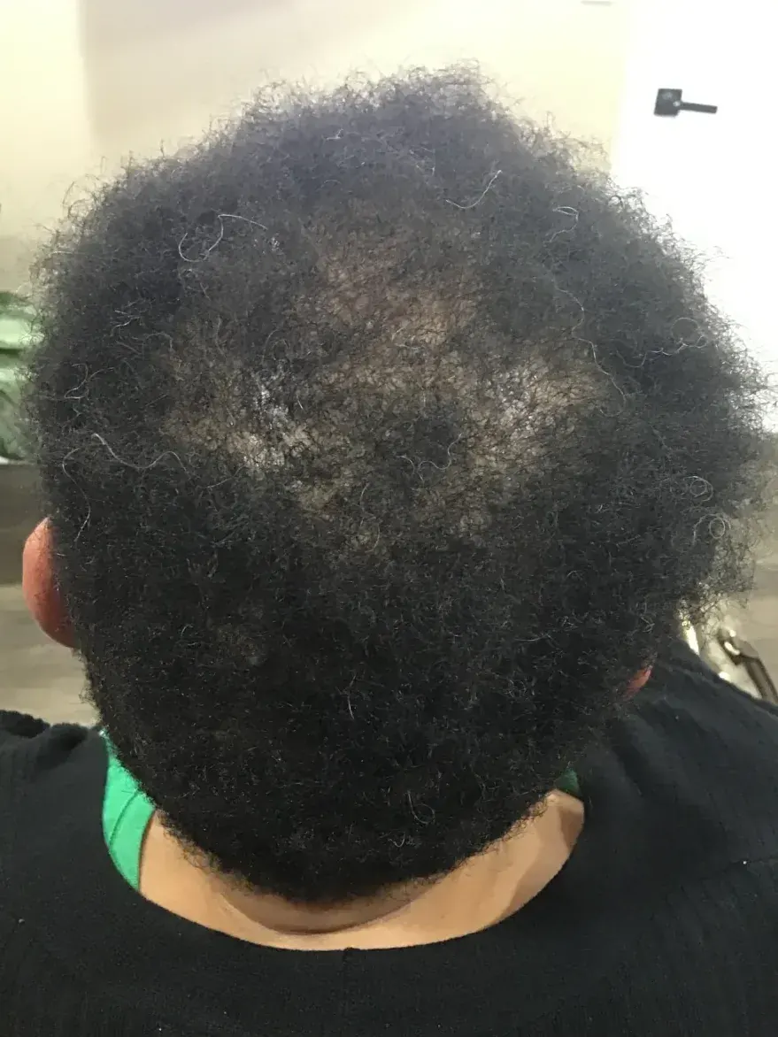 CCCA after 34 weeks of Inflammation control + Exosomes