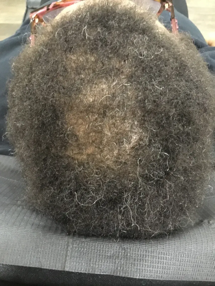 Female Pattern Hair Loss after 30 weeks of PRP + Nutraceuticals