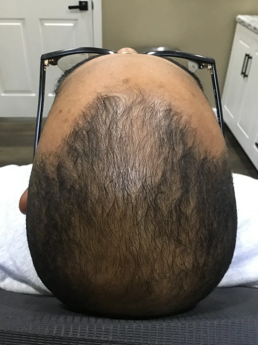 Androgenetic Alopecia after 36 weeks of PRP + Hormone support