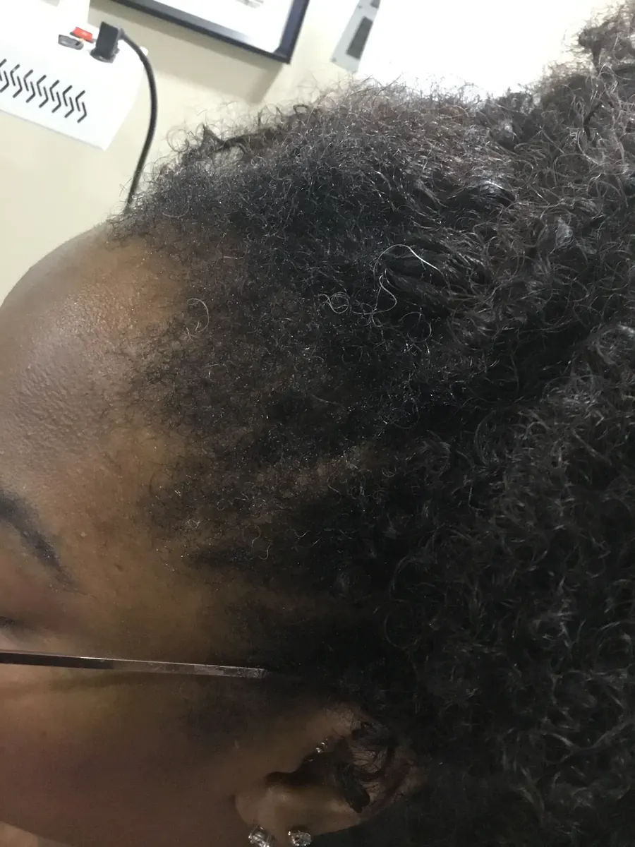 Traction Alopecia after 24 weeks of Trichoscopy + PRP