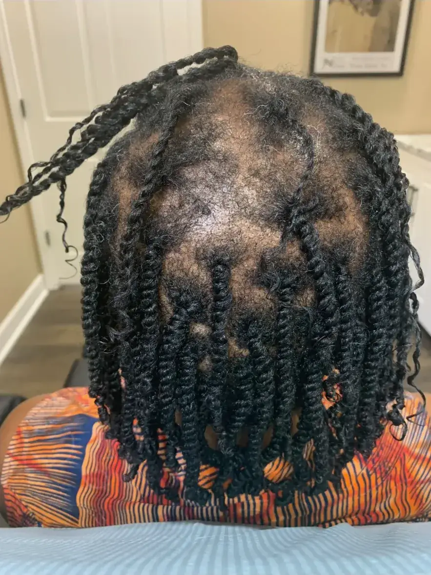 Traction Alopecia before trichology treatment: Protective-style recovery