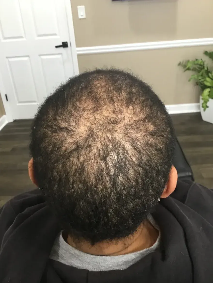 CCCA before trichology treatment: Central scalp regrowth