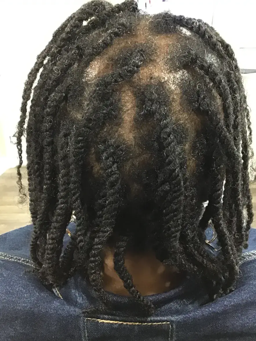 Traction Alopecia after 24 weeks of Scalp treatments + Microneedling