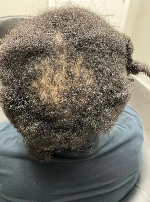 During treatment