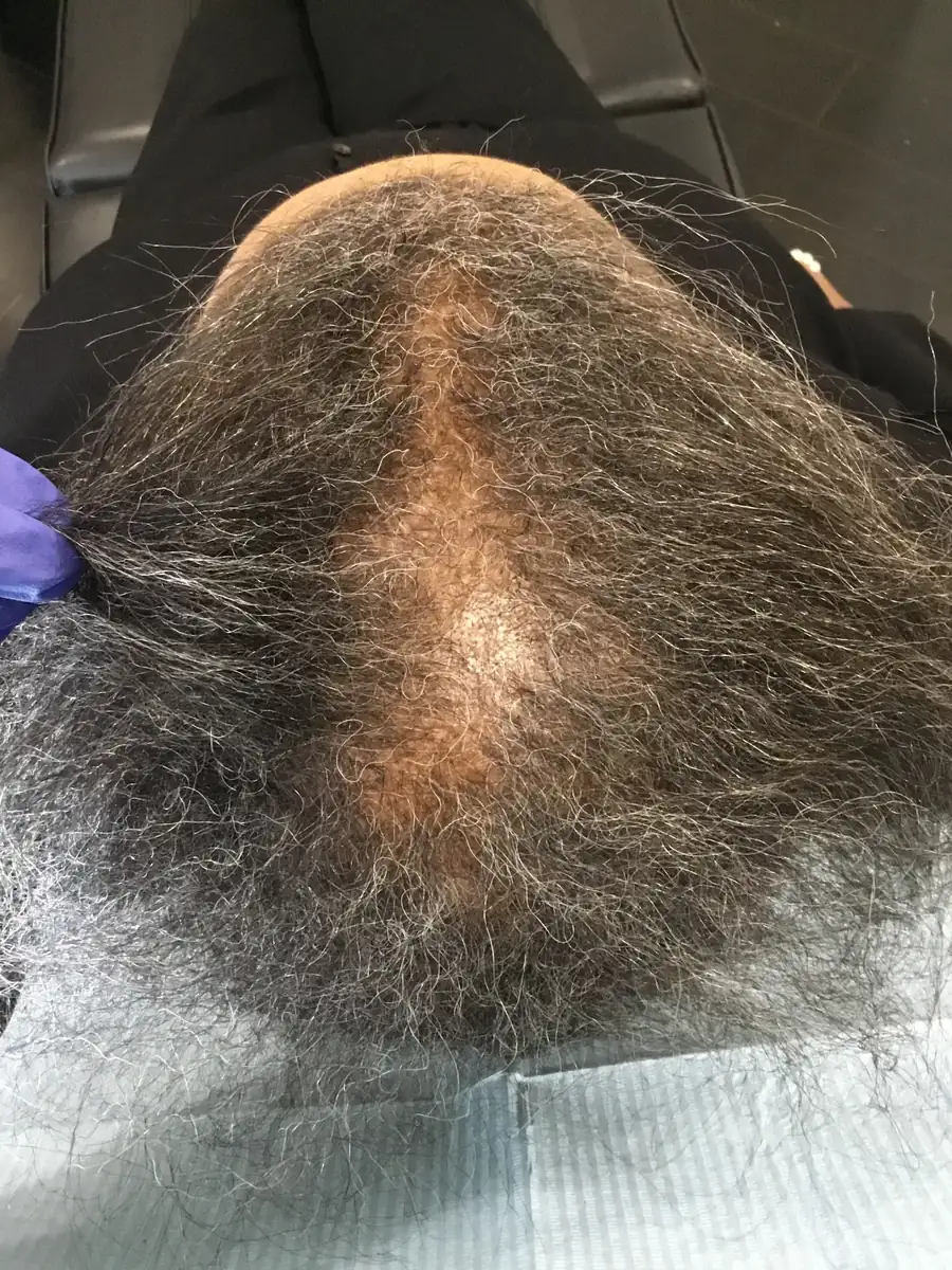 Diffuse Thinning before trichology treatment: Midline part density