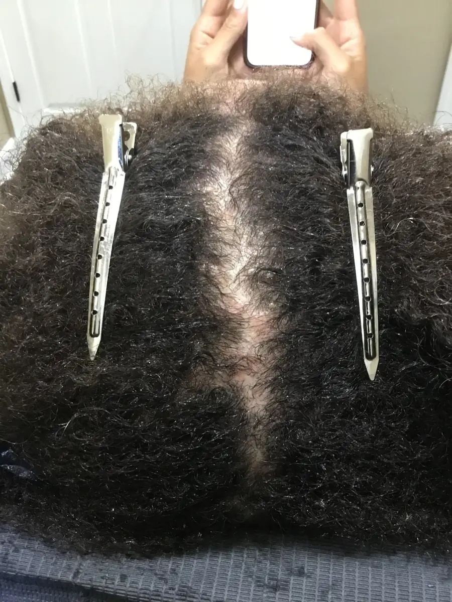 Diffuse Thinning before trichology treatment: Widened part correction