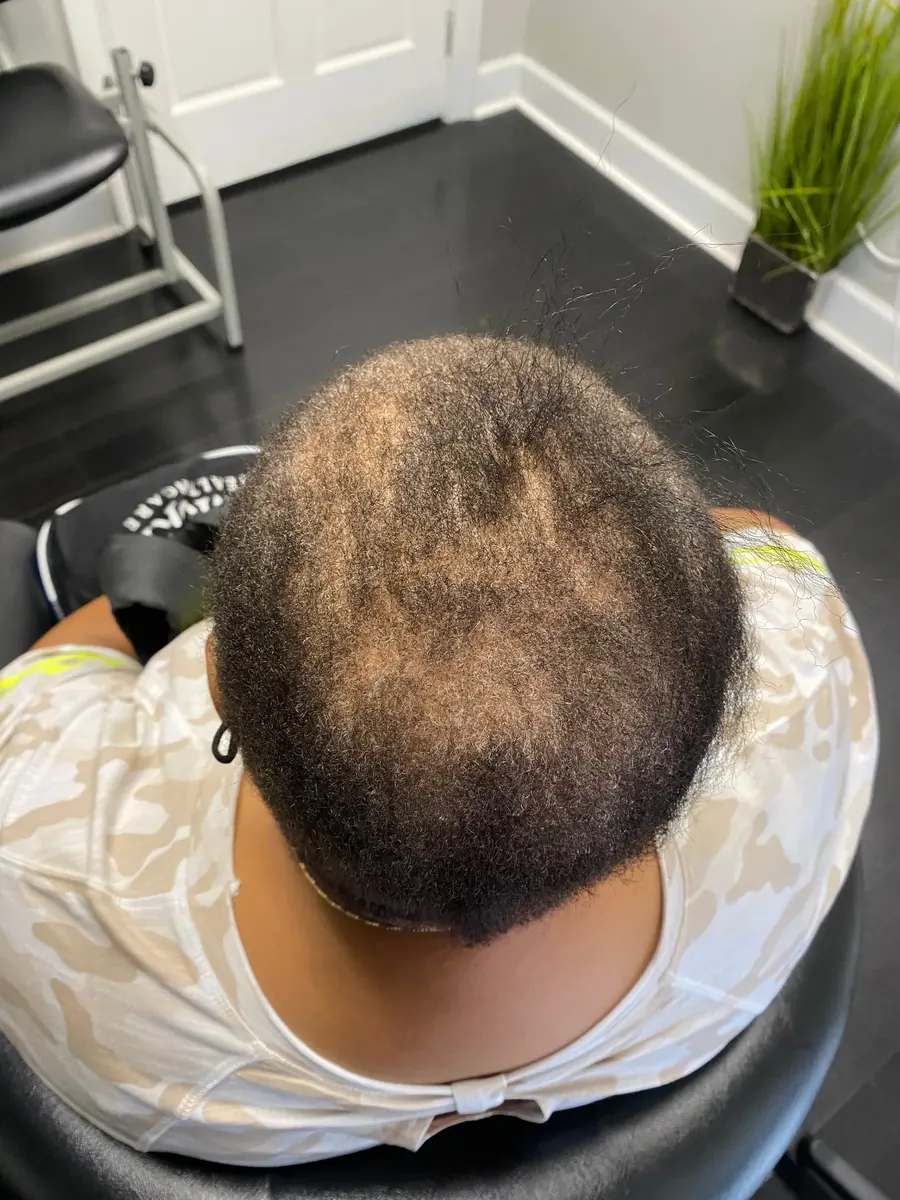 Diffuse Thinning before trichology treatment: Crown density gain