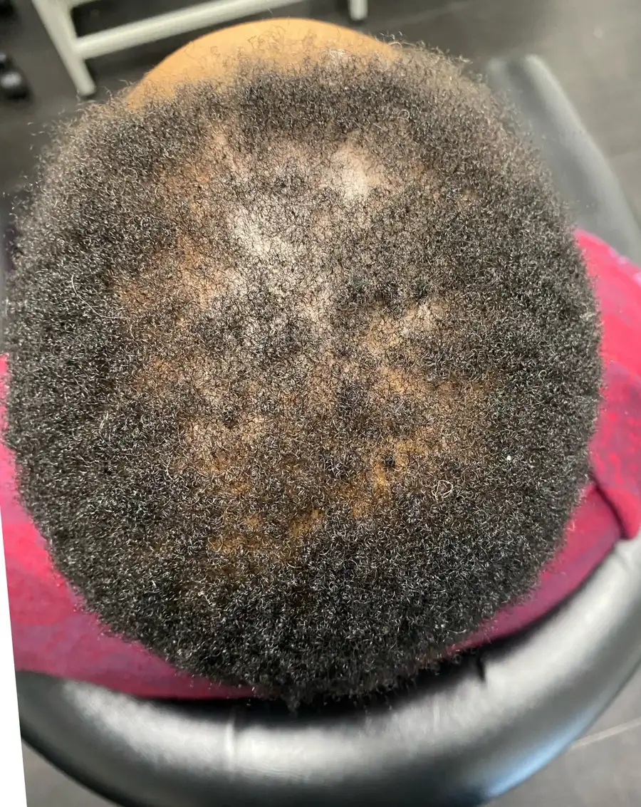 Alopecia Areata before trichology treatment: Patch resolution