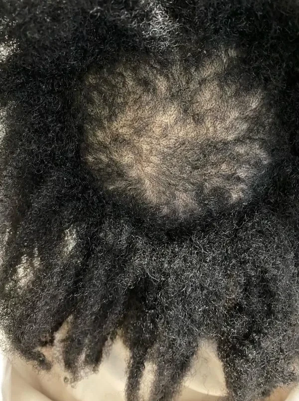 Before treatment