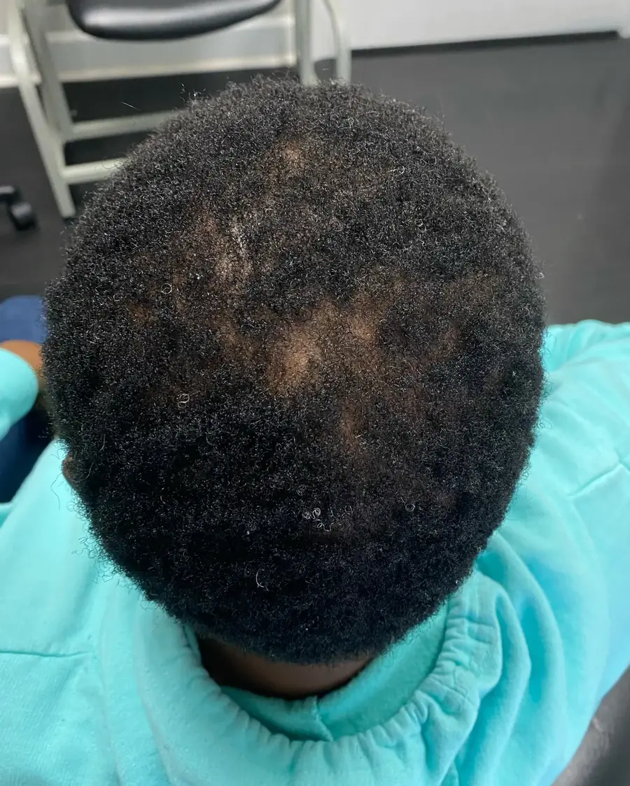Alopecia Areata after 18 weeks of Immune-directed protocol