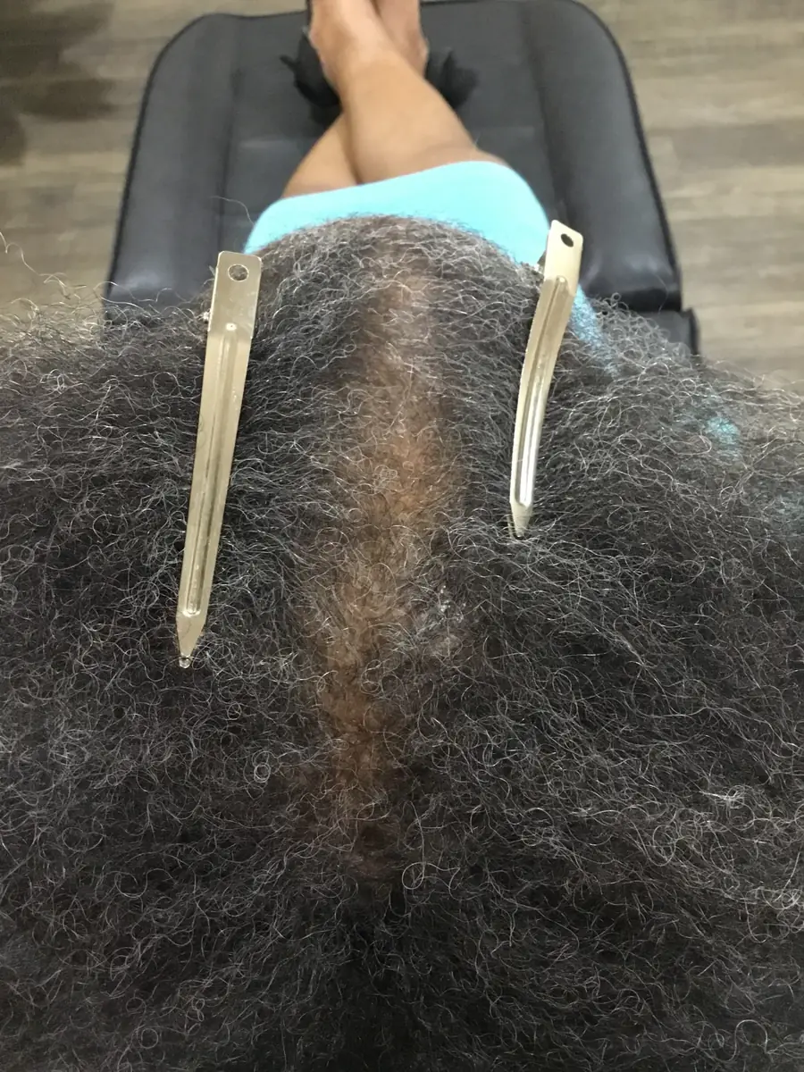 Diffuse Thinning after 22 weeks of Thyroid workup + Laser