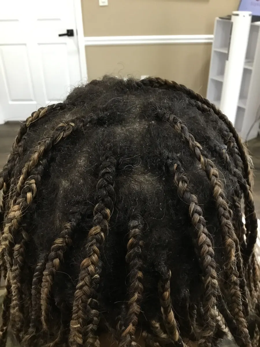 Diffuse Thinning after 20 weeks of Bloodwork-led supplementation + Laser