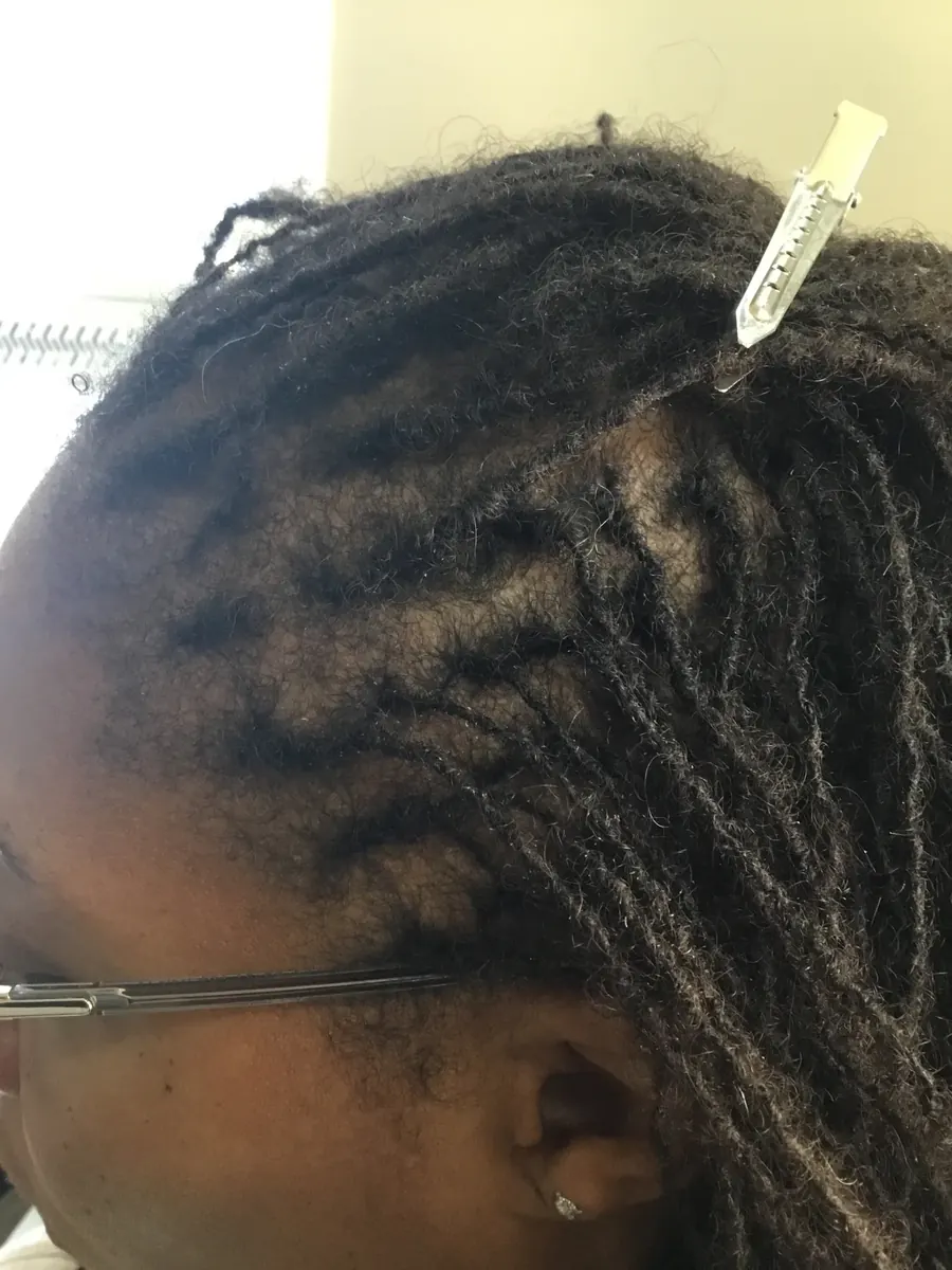 Traction Alopecia after 22 weeks of Tension relief protocol + PRP