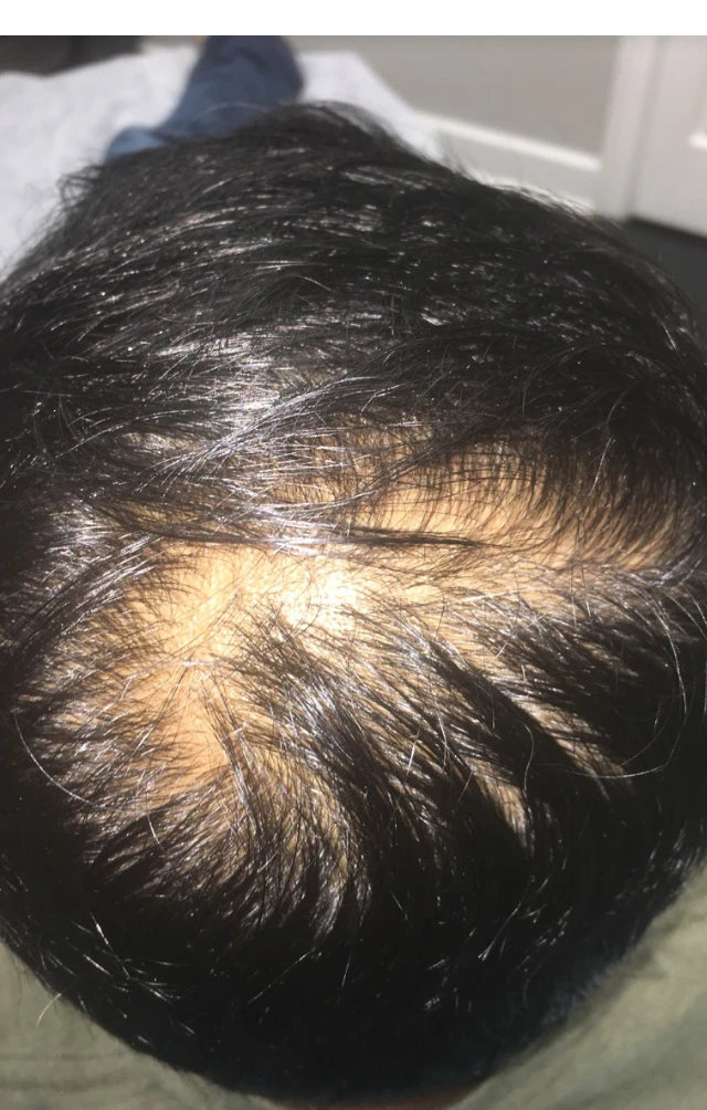 Androgenetic alopecia scalp at intake, month zero