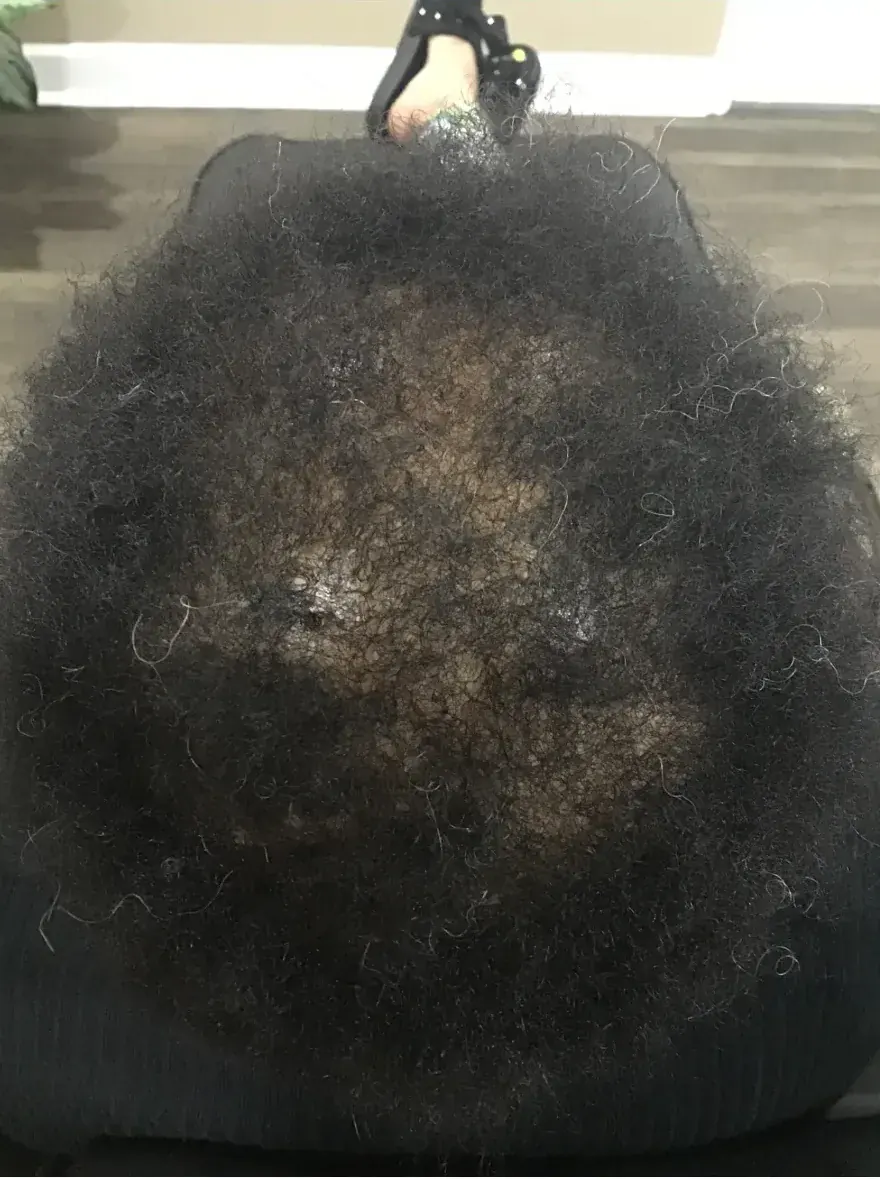 Androgenetic Alopecia after 38 weeks of PRP + Custom topicals