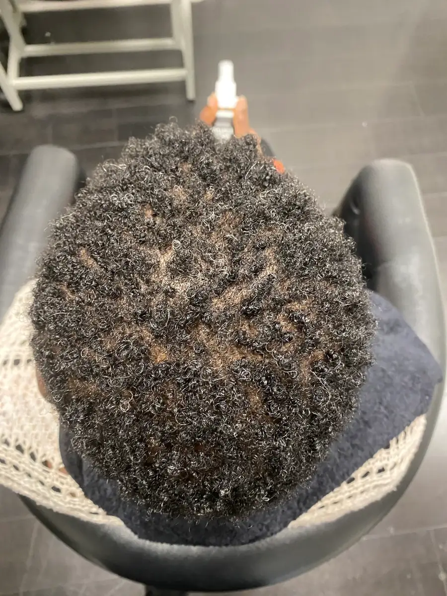 Scalp Inflammation after 14 weeks of Medicated scalp therapy