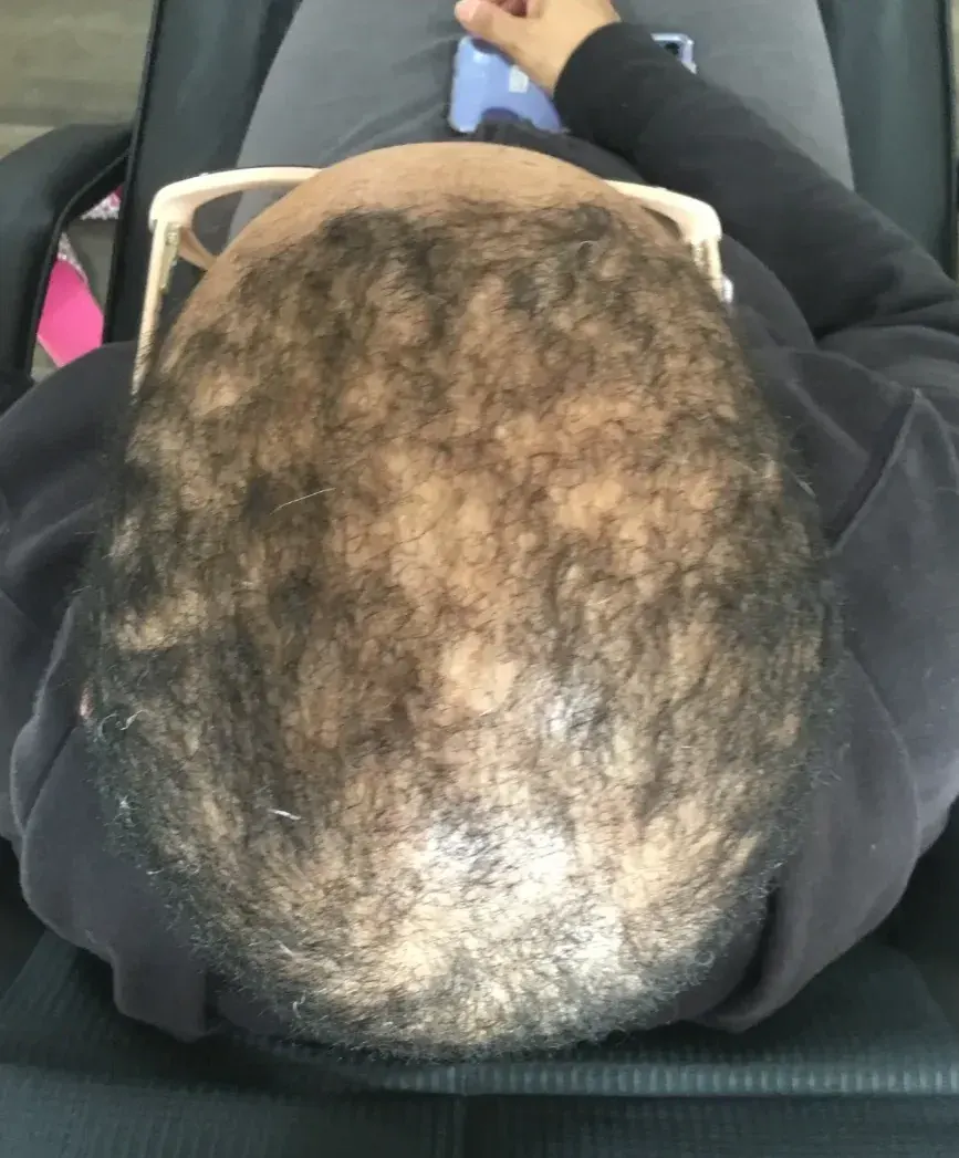 Androgenetic Alopecia before trichology treatment: Frontal & crown regrowth