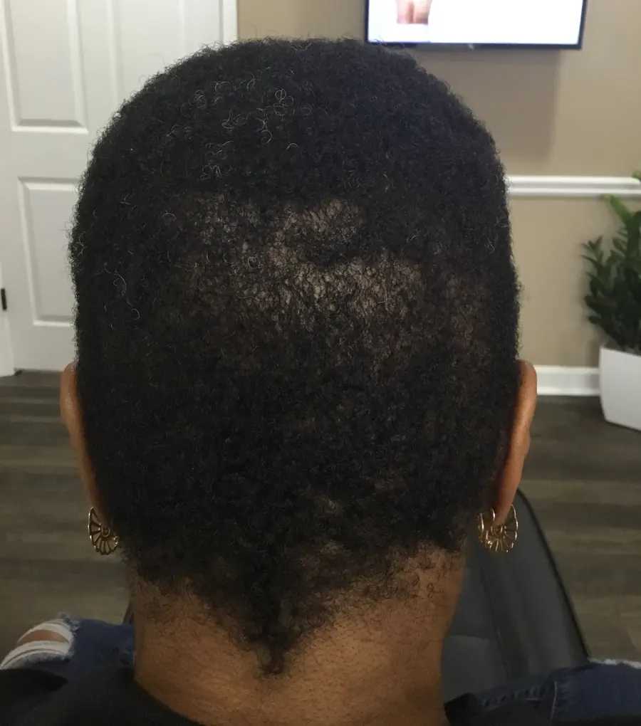 Traction Alopecia after 26 weeks of Scalp therapy + Microneedling