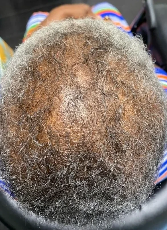 Metabolic hair loss scalp at intake, week zero