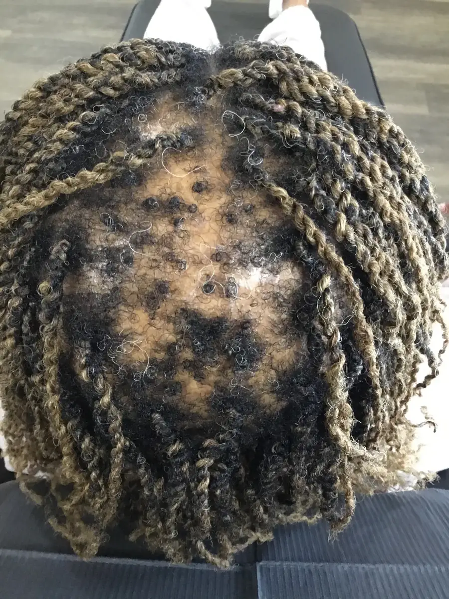 Alopecia Areata after 20 weeks of Functional medicine protocol