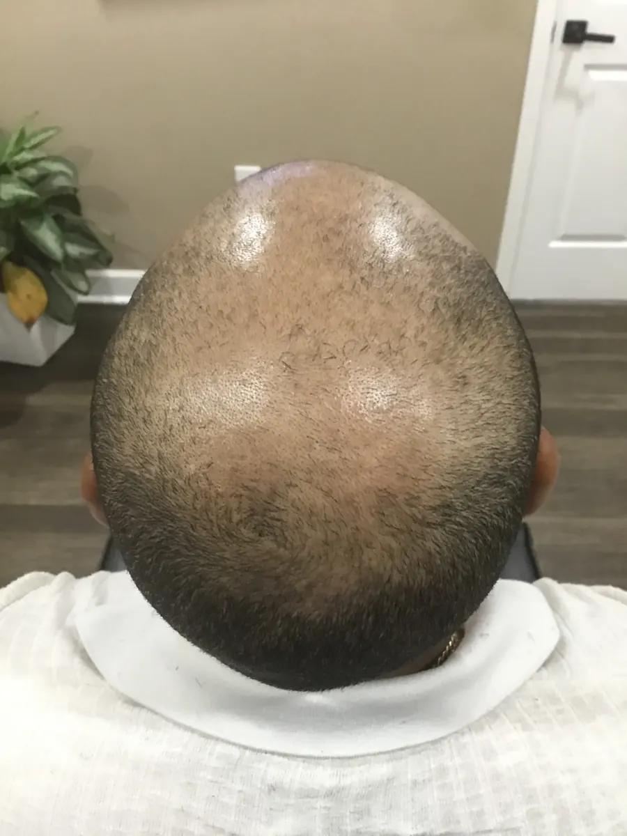 Androgenetic Alopecia before trichology treatment: Vertex coverage