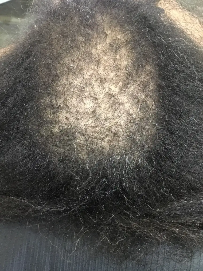 Female Pattern Hair Loss before trichology treatment: Crown fill-in