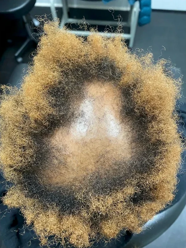 CCCA scalp at intake, week zero