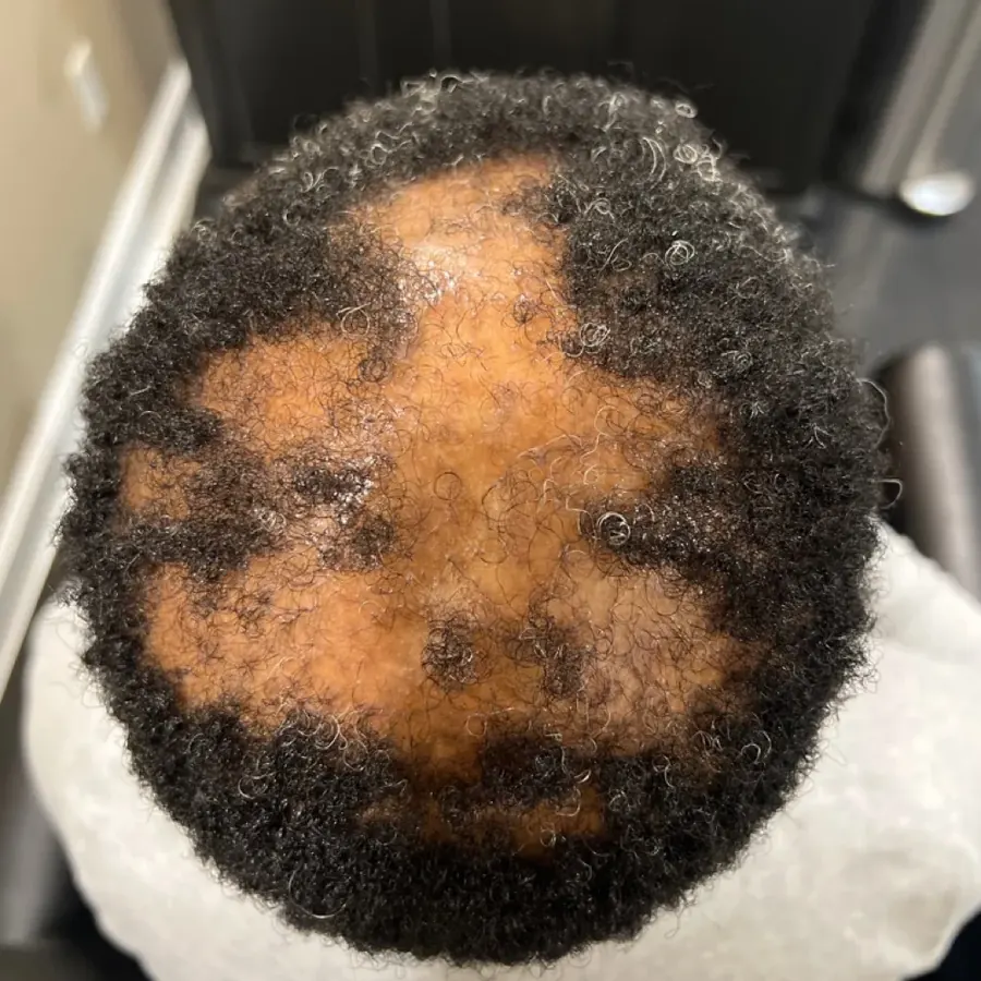 Alopecia Areata before trichology treatment: Multi-patch regrowth
