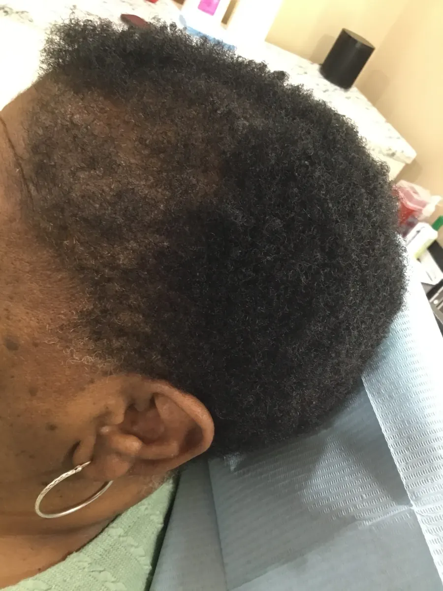 Frontal Hairline Recession after 26 weeks of Microneedling + PRP