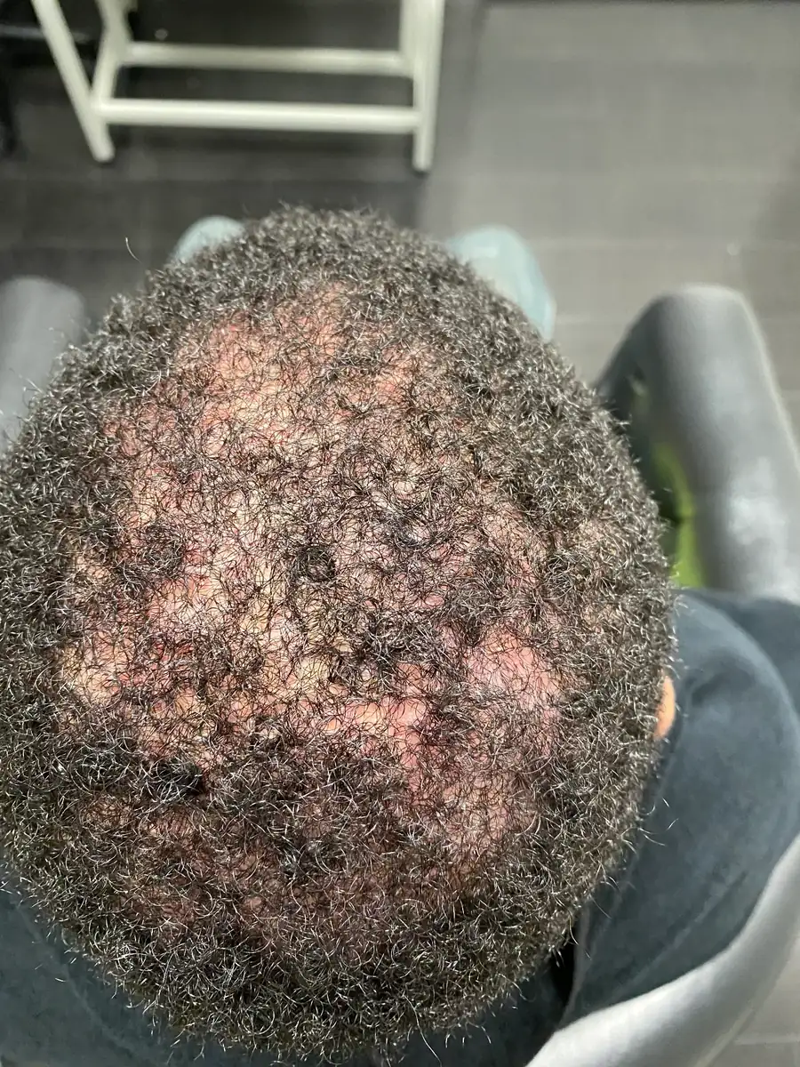 Scalp Inflammation before trichology treatment: Folliculitis clearance