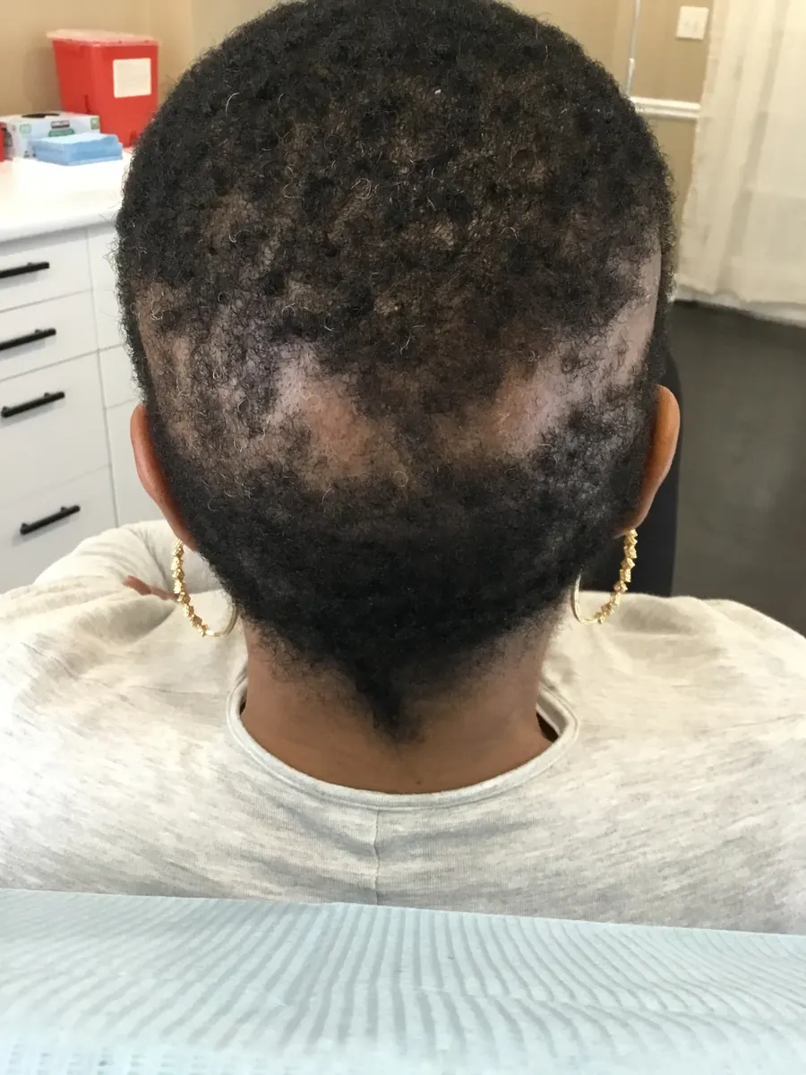 Traction Alopecia before trichology treatment: Nape & perimeter rebuild