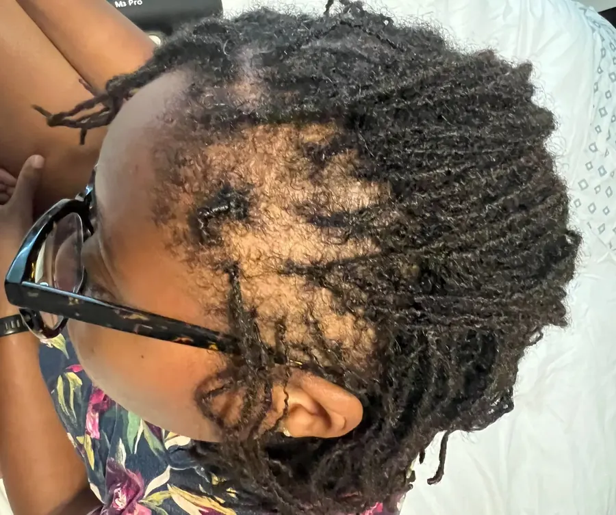 Traction Alopecia before trichology treatment: Loc-related edge loss