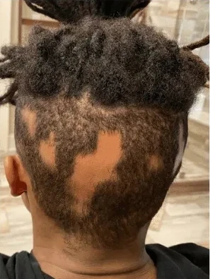Alopecia areata scalp at intake, week zero