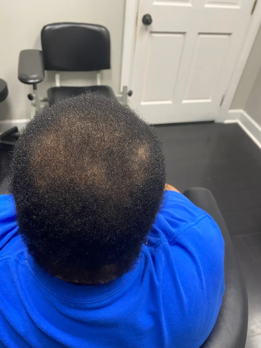Diffuse Thinning after 28 weeks of IV therapy + Laser