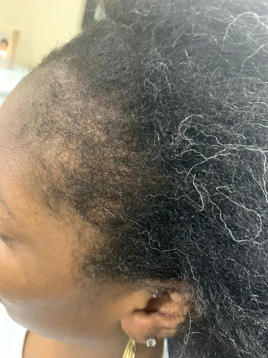 Traction Alopecia before trichology treatment: Temple & hairline regrowth