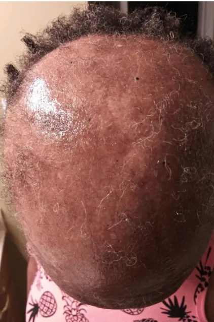 Advanced CCCA scalp at intake, month zero
