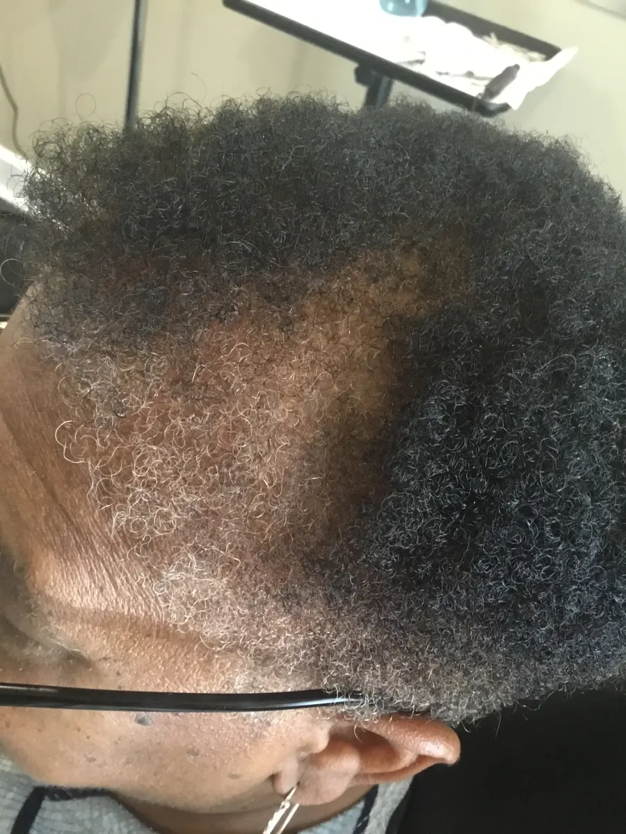 Frontal Hairline Recession before trichology treatment: Hairline reconstruction