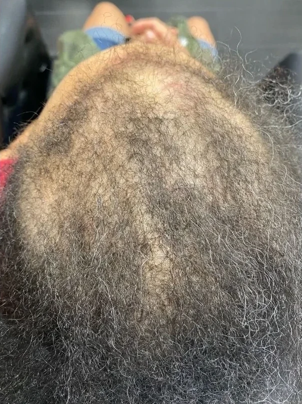Hormonal hair loss scalp at intake, week zero